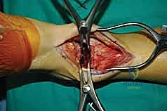 التخطيط الجراحي قبل العملية