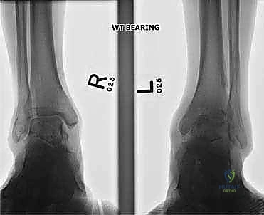 صورة توضيحية لـ تثبيت مفصل الكاحل الأمامي: حل فعال لخشونة الكاحل المزمنة مع الأستاذ الدكتور محمد هطيف