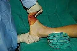 صورة طبية: تثبيت مفصل الكاحل الأمامي: حل فعال لخشونة الكاحل المزمنة مع الأستاذ الدكتور محمد هطيف