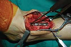 صورة طبية: تثبيت مفصل الكاحل الأمامي: حل فعال لخشونة الكاحل المزمنة مع الأستاذ الدكتور محمد هطيف