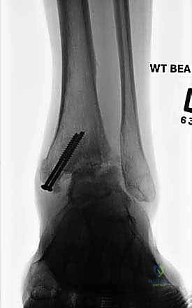 صورة طبية: تثبيت مفصل الكاحل الأمامي: حل فعال لخشونة الكاحل المزمنة مع الأستاذ الدكتور محمد هطيف