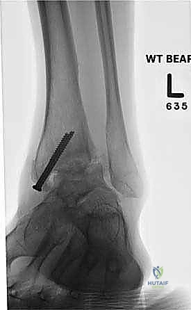 صورة طبية: تثبيت مفصل الكاحل الأمامي: حل فعال لخشونة الكاحل المزمنة مع الأستاذ الدكتور محمد هطيف