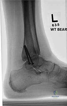 صورة طبية: تثبيت مفصل الكاحل الأمامي: حل فعال لخشونة الكاحل المزمنة مع الأستاذ الدكتور محمد هطيف