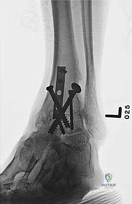 صورة طبية: تثبيت مفصل الكاحل الأمامي: حل فعال لخشونة الكاحل المزمنة مع الأستاذ الدكتور محمد هطيف