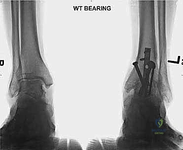 صورة طبية: تثبيت مفصل الكاحل الأمامي: حل فعال لخشونة الكاحل المزمنة مع الأستاذ الدكتور محمد هطيف