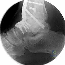صورة طبية: تثبيت مفصل الكاحل الأمامي: حل فعال لخشونة الكاحل المزمنة مع الأستاذ الدكتور محمد هطيف