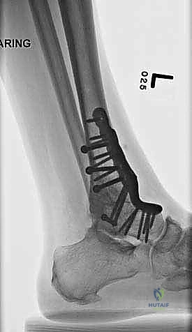 صورة طبية: تثبيت مفصل الكاحل الأمامي: حل فعال لخشونة الكاحل المزمنة مع الأستاذ الدكتور محمد هطيف