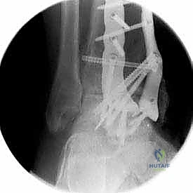 صورة طبية: تثبيت مفصل الكاحل الأمامي: حل فعال لخشونة الكاحل المزمنة مع الأستاذ الدكتور محمد هطيف