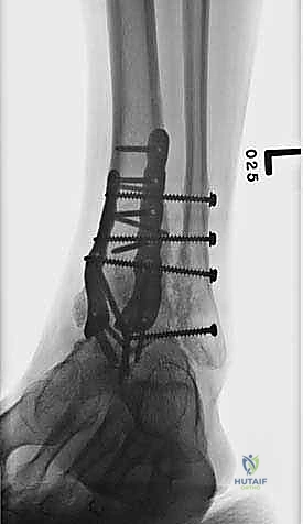 صورة طبية: تثبيت مفصل الكاحل الأمامي: حل فعال لخشونة الكاحل المزمنة مع الأستاذ الدكتور محمد هطيف