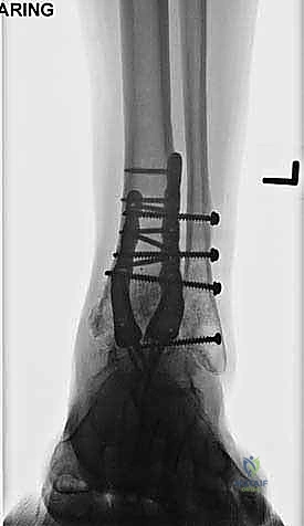صورة طبية: تثبيت مفصل الكاحل الأمامي: حل فعال لخشونة الكاحل المزمنة مع الأستاذ الدكتور محمد هطيف