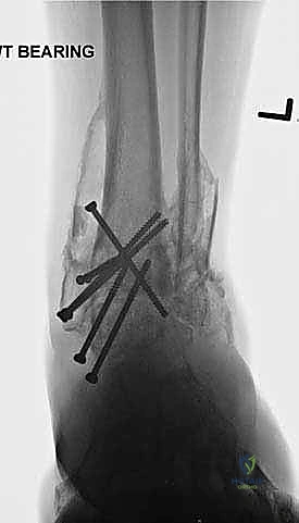 صورة طبية: تثبيت مفصل الكاحل الأمامي: حل فعال لخشونة الكاحل المزمنة مع الأستاذ الدكتور محمد هطيف
