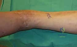 صورة طبية: تثبيت مفصل الكاحل الأمامي: حل فعال لخشونة الكاحل المزمنة مع الأستاذ الدكتور محمد هطيف