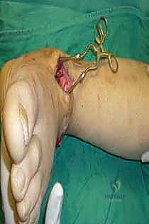 صورة طبية: تثبيت مفصل الكاحل الأمامي: حل فعال لخشونة الكاحل المزمنة مع الأستاذ الدكتور محمد هطيف