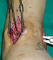 صورة طبية: تثبيت مفصل الكاحل الأمامي: حل فعال لخشونة الكاحل المزمنة مع الأستاذ الدكتور محمد هطيف