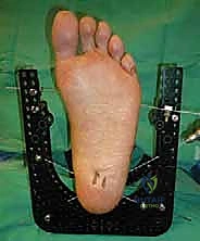 صورة طبية: تثبيت مفصل الكاحل الأمامي: حل فعال لخشونة الكاحل المزمنة مع الأستاذ الدكتور محمد هطيف