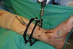 صورة طبية: تثبيت مفصل الكاحل الأمامي: حل فعال لخشونة الكاحل المزمنة مع الأستاذ الدكتور محمد هطيف