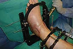 صورة طبية: تثبيت مفصل الكاحل الأمامي: حل فعال لخشونة الكاحل المزمنة مع الأستاذ الدكتور محمد هطيف