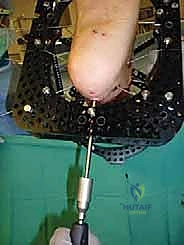 صورة طبية: تثبيت مفصل الكاحل الأمامي: حل فعال لخشونة الكاحل المزمنة مع الأستاذ الدكتور محمد هطيف