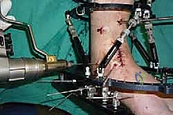 صورة طبية: تثبيت مفصل الكاحل الأمامي: حل فعال لخشونة الكاحل المزمنة مع الأستاذ الدكتور محمد هطيف