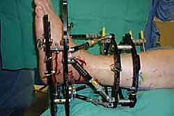 صورة طبية: تثبيت مفصل الكاحل الأمامي: حل فعال لخشونة الكاحل المزمنة مع الأستاذ الدكتور محمد هطيف