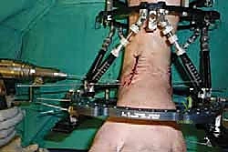 صورة طبية: تثبيت مفصل الكاحل الأمامي: حل فعال لخشونة الكاحل المزمنة مع الأستاذ الدكتور محمد هطيف