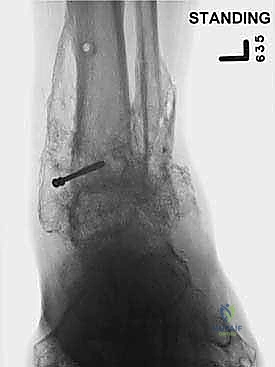 صورة طبية: تثبيت مفصل الكاحل الأمامي: حل فعال لخشونة الكاحل المزمنة مع الأستاذ الدكتور محمد هطيف