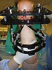 صورة طبية: تثبيت مفصل الكاحل الأمامي: حل فعال لخشونة الكاحل المزمنة مع الأستاذ الدكتور محمد هطيف