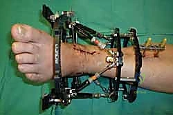 صورة طبية: تثبيت مفصل الكاحل الأمامي: حل فعال لخشونة الكاحل المزمنة مع الأستاذ الدكتور محمد هطيف