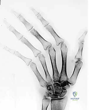 تطور التشوه والانحراف الزندي في اليد الروماتويدية