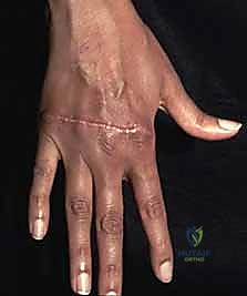 مقارنة سر
![صورة طبية: استئصال الغشاء الزليلي وتوسيط الوتر الباسط لمفصل MCP: حل فعال لالتهاب المفاصل الروماتويدي في اليد