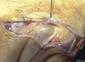 صورة توضيحية لـ استئصال الغشاء الزليلي وتوسيط الوتر الباسط لمفصل MCP: حل فعال لالتهاب المفاصل الروماتويدي في اليد