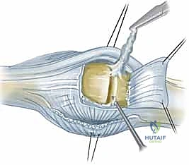 تشريح مفصل MCP وتأثير التهاب المفاصل الروماتويدي