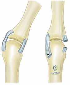 صورة توضيحية لـ استئصال الغشاء الزليلي وتوسيط الوتر الباسط لمفصل MCP: حل فعال لالتهاب المفاصل الروماتويدي في اليد