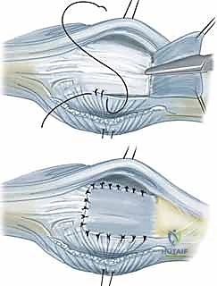 استئصال الغشاء الزليلي وتوسيط الوتر الباسط لمفصل MCP: حل فعال لالتهاب المفاصل الروماتويدي في اليد