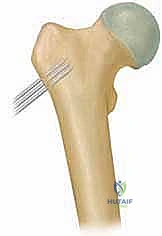 Illustration of developmental coxa vara - Dr. Mohammed Hutaif