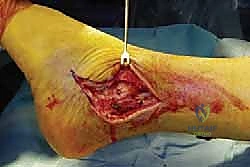 صورة توضيحية لـ دمج مفصل الكاحل عبر الشظية: حل جذري لالتهاب المفاصل المتقدم مع الأستاذ الدكتور محمد هطيف