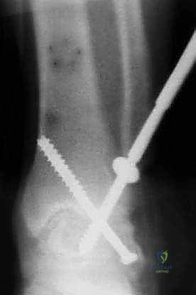 صورة طبية: دمج مفصل الكاحل عبر الشظية: حل جذري لالتهاب المفاصل المتقدم مع الأستاذ الدكتور محمد هطيف