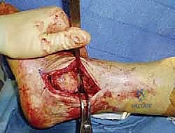 صورة طبية: دمج مفصل الكاحل عبر الشظية: حل جذري لالتهاب المفاصل المتقدم مع الأستاذ الدكتور محمد هطيف