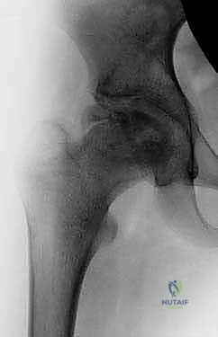 Illustration of osteotomy for perthes - Dr. Mohammed Hutaif