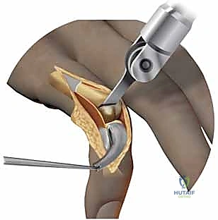 Illustration of surface replacement arthroplasty - Dr. Mohammed Hutaif