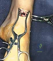 صورة توضيحية لـ تثبيت مفصل الكاحل بالشق الجراحي المصغر: دليل شامل لمرضى خشونة الكاحل