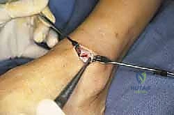 مقارنة العلاجات