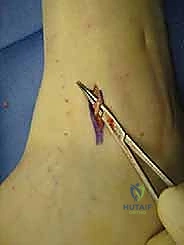 التخطيط الجراحي والأشعة المقطعية