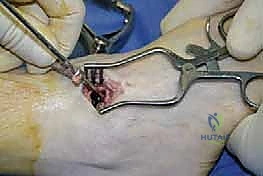 صورة توضيحية لـ تثبيت مفصل الكاحل بالشق الجراحي المصغر: دليل شامل لمرضى خشونة الكاحل