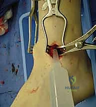 صورة طبية: تثبيت مفصل الكاحل بالشق الجراحي المصغر: دليل شامل لمرضى خشونة الكاحل