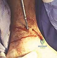 صورة توضيحية لـ تثبيت مفصل الكاحل بالشق الجراحي المصغر: دليل شامل لمرضى خشونة الكاحل