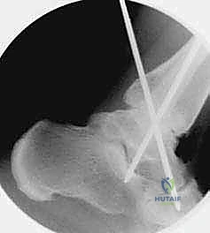 صورة توضيحية لـ تثبيت مفصل الكاحل بالشق الجراحي المصغر: دليل شامل لمرضى خشونة الكاحل