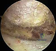 الأستاذ الدكتور محمد هطيف أثناء إجراء عملية تنظير للكتف