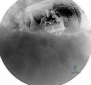 مقارنة بين خيارات علاج الكتف