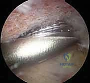 Illustration of arthroscopic subacromial decompression - Dr. Mohammed Hutaif